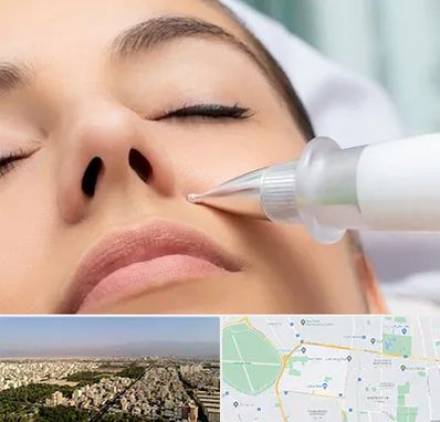 پلاسما جت بینی در نازی آباد