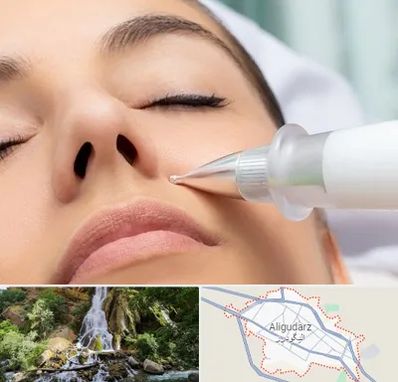 پلاسما جت بینی در الیگودرز