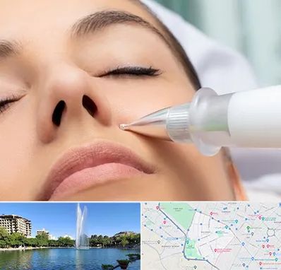 پلاسما جت بینی در کوهسنگی مشهد