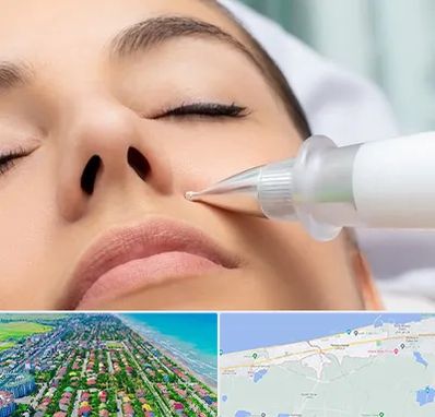 پلاسما جت بینی در فریدونکنار