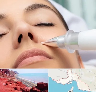 پلاسما جت بینی در هرمزگان