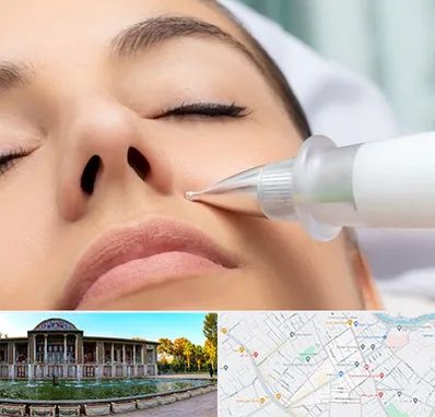 پلاسما جت بینی در عفیف آباد شیراز