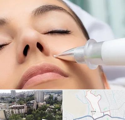 پلاسما جت بینی در اوین