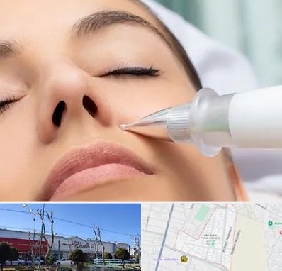 پلاسما جت بینی در فاز دو اندیشه