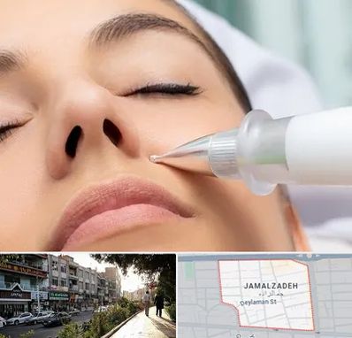 پلاسما جت بینی در خیابان جمالزاده