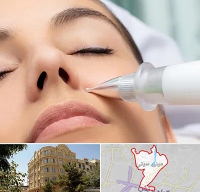 پلاسما جت بینی در مینی سیتی