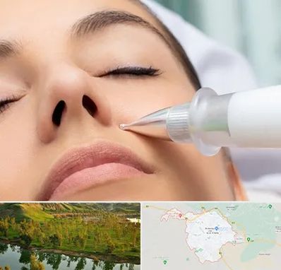 پلاسما جت بینی در بهبهان