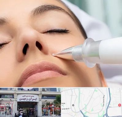 پلاسما جت بینی در ایران زمین