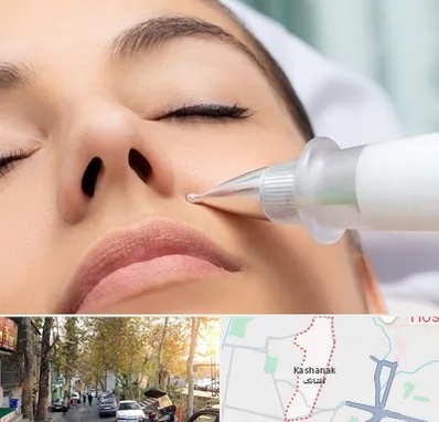 پلاسما جت بینی در کاشانک