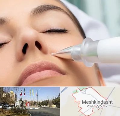 پلاسما جت بینی در مشکین دشت