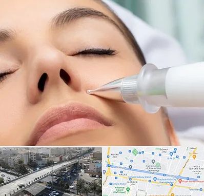 پلاسما جت بینی در فرجام