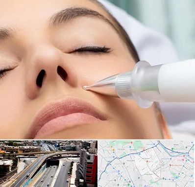 پلاسما جت بینی در ستارخان شیراز