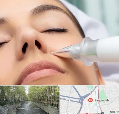 پلاسما جت بینی در زرگنده