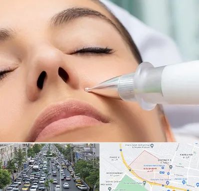 پلاسما جت بینی در گلشهر کرج