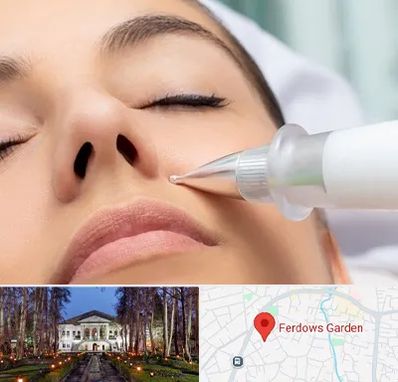 پلاسما جت بینی در باغ فردوس