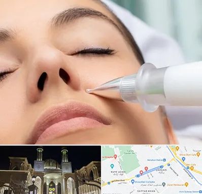 پلاسما جت بینی در زرگری شیراز