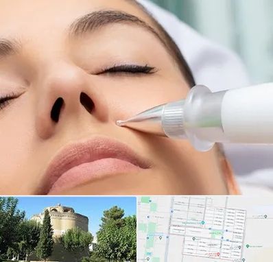 پلاسما جت بینی در مرداویج اصفهان