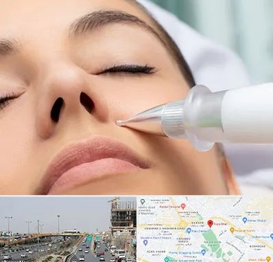 پلاسما جت بینی در بلوار توس مشهد