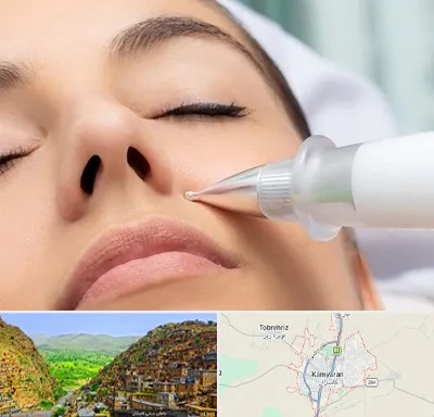پلاسما جت بینی در کامیاران