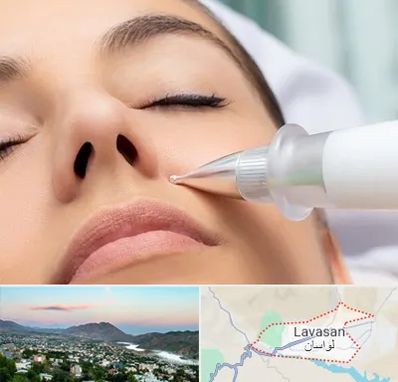 پلاسما جت بینی در لواسان