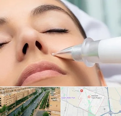 پلاسما جت بینی در فاز سه اندیشه