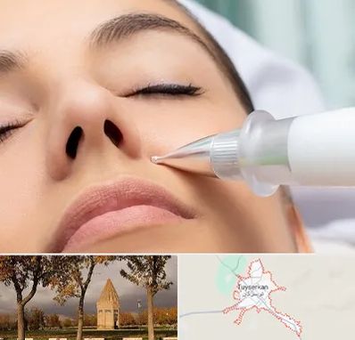 پلاسما جت بینی در تویسرکان