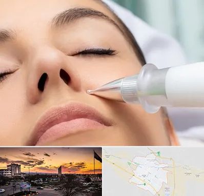 پلاسما جت بینی در قوچان