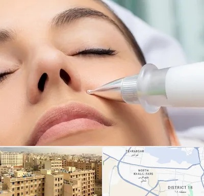 پلاسما جت بینی در جنوب غرب تهران