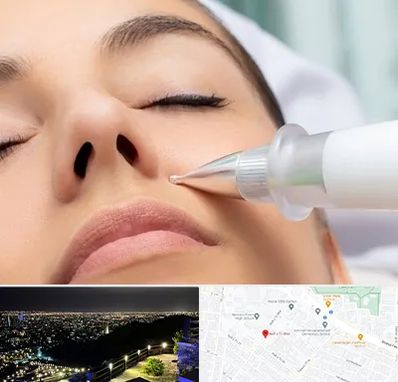 پلاسما جت بینی در هفت تیر مشهد