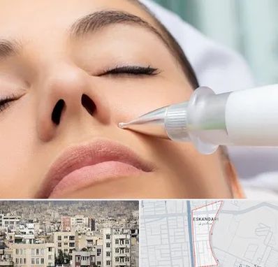 پلاسما جت بینی در اسکندری