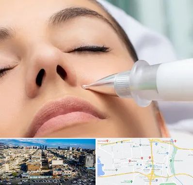 پلاسما جت بینی در شهرک راه آهن