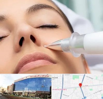 پلاسما جت بینی در نصف راه تبریز