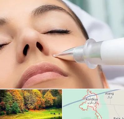 پلاسما جت بینی در کردکوی