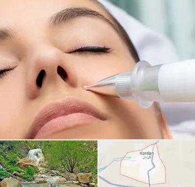 پلاسما جت بینی در کردان