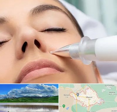 پلاسما جت بینی در مرند