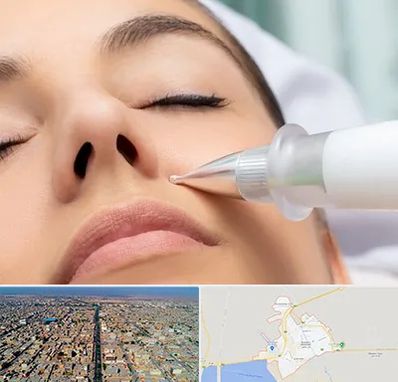 پلاسما جت بینی در بندر ماهشهر