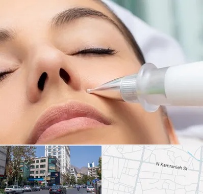 پلاسما جت بینی در کامرانیه
