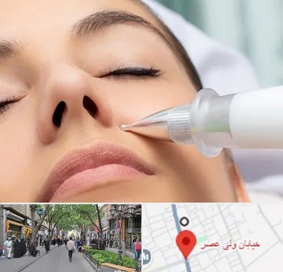 پلاسما جت بینی در ولیعصر شهریار