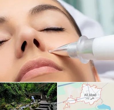 پلاسما جت بینی در علی آباد کتول