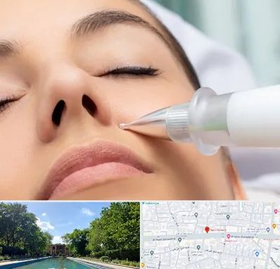 پلاسما جت بینی در هشت بهشت اصفهان