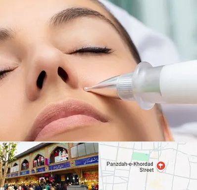 پلاسما جت بینی در 15 خرداد