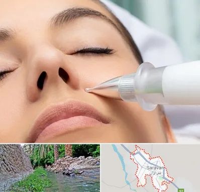 پلاسما جت بینی در سراوان