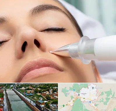 پلاسما جت بینی در مراغه