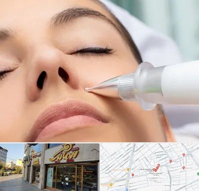 پلاسما جت بینی در عطاران قم