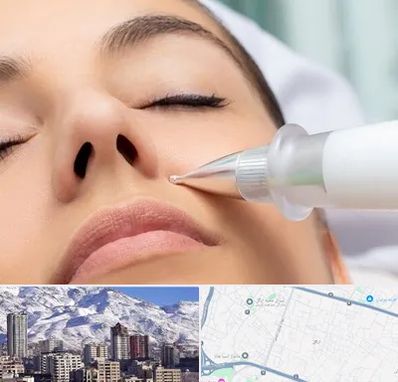 پلاسما جت بینی در ازگل