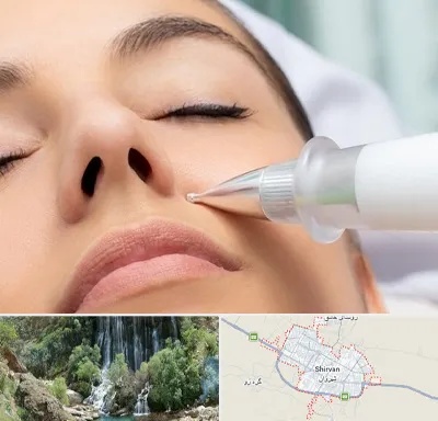 پلاسما جت بینی در شیروان
