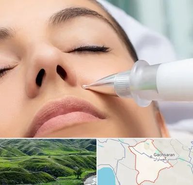پلاسما جت بینی در گچساران