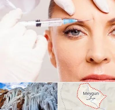 مزوژل در میگون