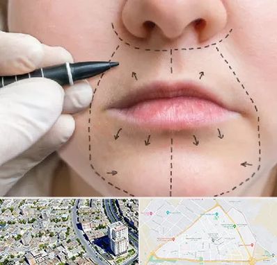 عمل سانترال لب در قاسم آباد مشهد