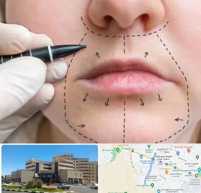 عمل سانترال لب در صیاد شیرازی مشهد